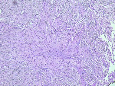 Anatomik patoloji laboratuvarında meningolial menenjiyom yumuşak doku tümörünün fotokopisi.