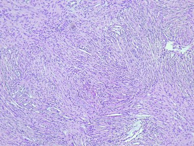 Photomicrograph of meningothelial meningioma soft tissue tumor in anatomical pathology laboratory clipart