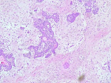 Anatomik patoloji laboratuarında submandibular bölge tümöründe fotomikrograf pleomorfik adenoma