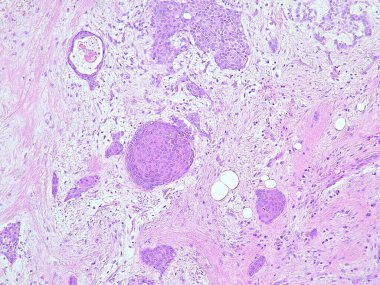Anatomik patoloji laboratuarında submandibular bölge tümöründe fotomikrograf pleomorfik adenoma
