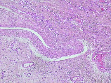 Anatomik patoloji laboratuvarının sağ bacak bölgesinde iyi huylu dev hücre tümörü (GCT)