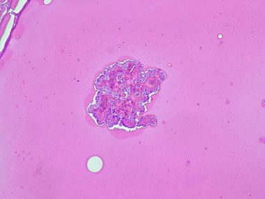 photomicrograph of Hashimoto's thyroiditis (chronic lymphocytic thyroiditis) in pathology anatomy laboratory clipart