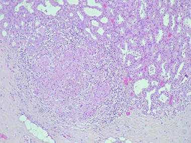 Hamile bir kadından alınan göğüs biyopsisi fotografı anatomi laboratuvarında mikroskop altında emziren bir adenoma gösterdi.