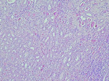 Photomicrograph of pyonephrosis + angiomyolipoma in a patient diagnosed with pyonephrosis sinistra in the anatomical pathology laboratory clipart