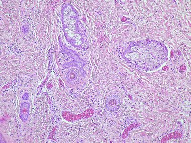 Anatomik patoloji laboratuvarındaki lobulus auricula üzerinde bir atheroma kistinin histolojisini gösteren fotoğraf.