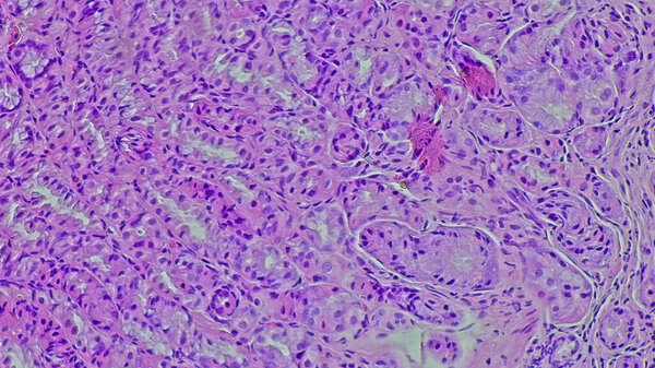 Микроскопическая фотография биопсии желудка, показывающая хронический неспецифический гастрит с меленой гематомезиса в патологической лаборатории.