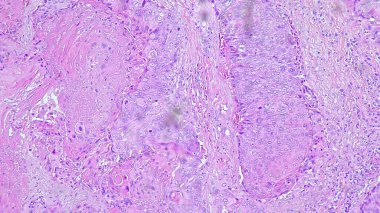 Skuamöz hücre kanserinin fotomikrografı koli lateral alisinin keratinizasyonu, mikroskop altında anatomik patoloji laboratuvarında fotoğraf.