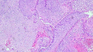 Skuamöz hücre kanserinin fotomikrografı koli lateral alisinin keratinizasyonu, mikroskop altında anatomik patoloji laboratuvarında fotoğraf.