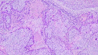 Skuamöz hücre kanserinin fotomikrografı koli lateral alisinin keratinizasyonu, mikroskop altında anatomik patoloji laboratuvarında fotoğraf.