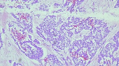 Tek başına adenokarsinom lifli mezenteryum mikroskop altında Histolojik doku.