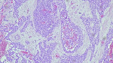 Tek başına adenokarsinom lifli mezenteryum mikroskop altında Histolojik doku.