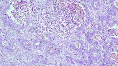 Sol frontal intrakraniyal bölgede adenokarsinom metastazı anatomik patoloji laboratuvarında mikroskop altında görülmektedir.