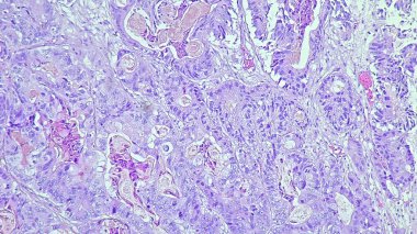 Sol frontal intrakraniyal bölgede adenokarsinom metastazı anatomik patoloji laboratuvarında mikroskop altında görülmektedir.