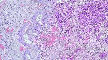 Sol frontal intrakraniyal bölgede adenokarsinom metastazı anatomik patoloji laboratuvarında mikroskop altında görülmektedir.