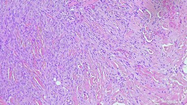Aterom kisti histolojisini ve anatomik patoloji laboratuvarının dektra gluteus bölgesinde enflamasyon olduğunu gösteren mikrograf..