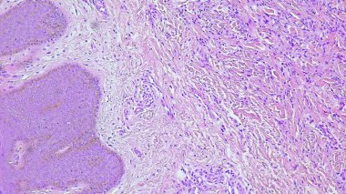 Aterom kisti histolojisini ve anatomik patoloji laboratuvarının dektra gluteus bölgesinde enflamasyon olduğunu gösteren mikrograf..