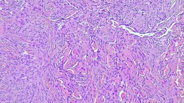 Aterom kisti histolojisini ve anatomik patoloji laboratuvarının dektra gluteus bölgesinde enflamasyon olduğunu gösteren mikrograf..