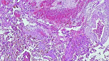 Sağ frontal temporal intrakraniyal bölgede kavernöz hemanjiyomun tariholojisi, anatomik patoloji laboratuvarında mikroskop altında görüntüleme.