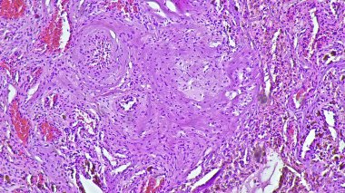 Sağ frontal temporal intrakraniyal bölgede kavernöz hemanjiyomun tariholojisi, anatomik patoloji laboratuvarında mikroskop altında görüntüleme.