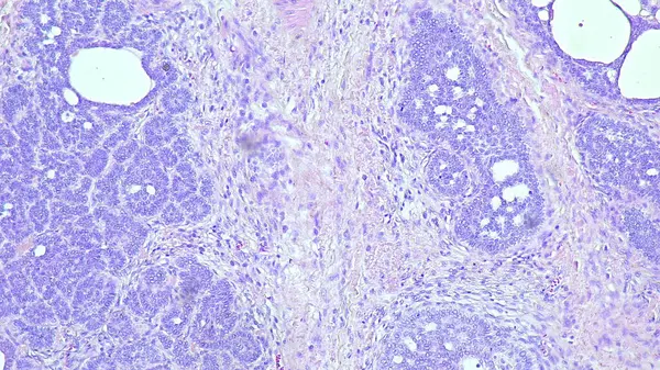 Geniz bölgesinin yumuşak dokusunda bulunan bazal hücre kanserinin mikroskop altında fotokopisi.