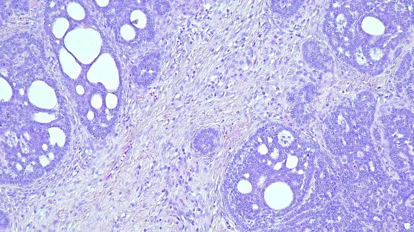 Geniz bölgesinin yumuşak dokusunda bulunan bazal hücre kanserinin mikroskop altında fotokopisi.