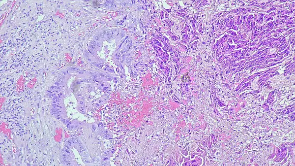 Sol frontal intrakraniyal bölgede adenokarsinom metastazı anatomik patoloji laboratuvarında mikroskop altında görülmektedir.
