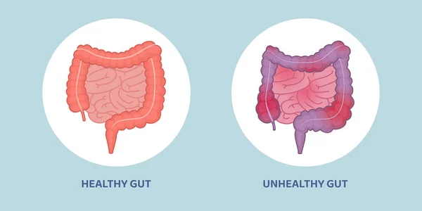 健康な腸と不健康な炎症腸の比較 — ストックベクタ