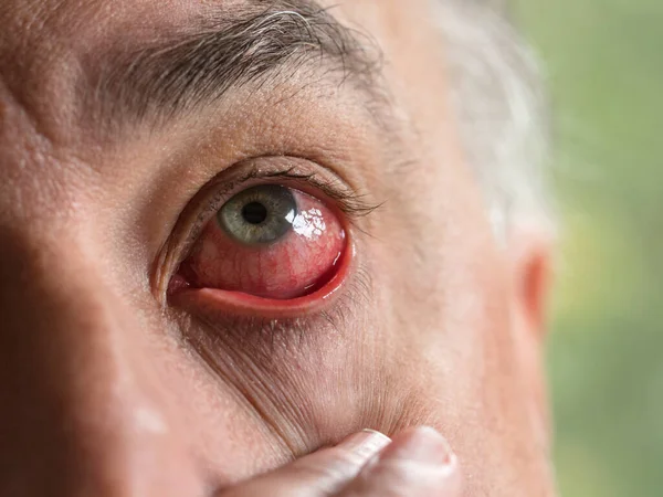 vascular injected red eyes, conjunctivitis