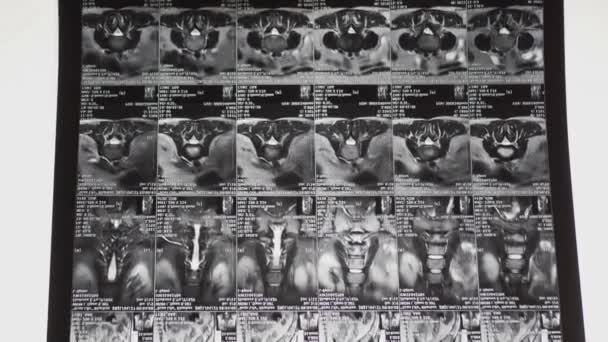 Vídeo Futurista Visualización Multifacética Una Radiografía Espalda Una Persona Enferma — Vídeos de Stock