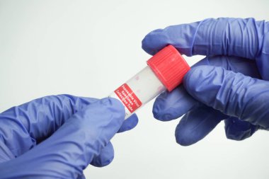 Cam test tüpü ve bir bilim adamının ellerinde pamuk çubuğu. Lastik tek kullanımlık eldivenler giyen bir virüs uzmanı laboratuvar şişesi tutuyor ve analiz için. Coronavirus testi için kan örneği aldı..