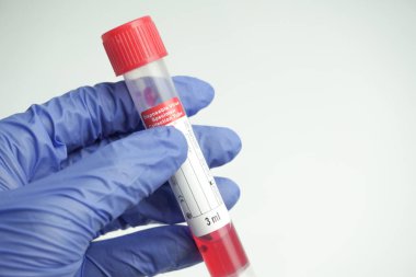 Cam test tüpü ve bir bilim adamının ellerinde pamuk çubuğu. Lastik tek kullanımlık eldivenler giyen bir virüs uzmanı laboratuvar şişesi tutuyor ve analiz için. Coronavirus testi için kan örneği aldı..