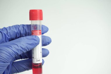 Cam test tüpü ve bir bilim adamının ellerinde pamuk çubuğu. Lastik tek kullanımlık eldivenler giyen bir virüs uzmanı laboratuvar şişesi tutuyor ve analiz için. Coronavirus testi için kan örneği aldı..