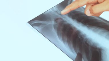 Doktor göğüs röntgenine bakıyor..