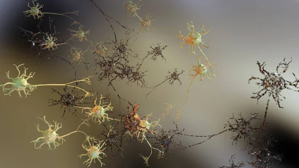 Leichte Traumatische Hirnverletzungen Beschädigte Neuronen Alzheimer Diffuse Axonale Verletzungen Störung — Stockfoto