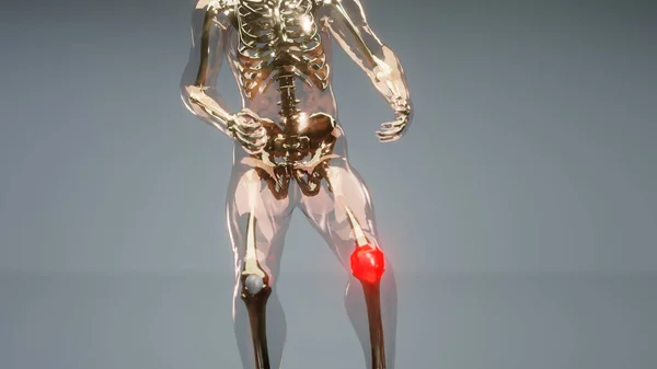 膝の痛みや痛みにつながる痛み 膝の痛みに苦しむ男 変形性関節症と健康的な関節と不健康な痛みの関節 膝の前に痛み領域を示すX線ホログラム 3Dレンダリング — ストック写真