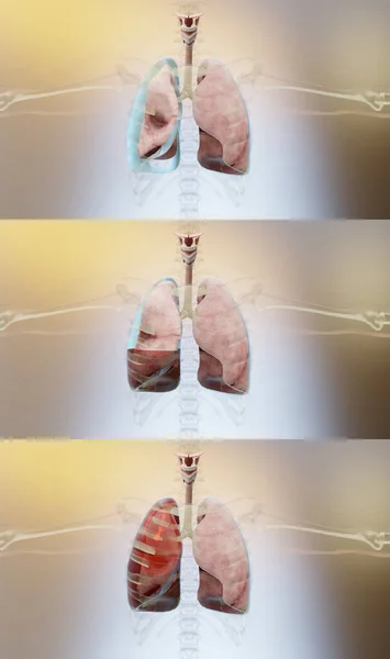 Illustration Von Pneumothorax Hämothorax Und Hämopneumothorax Normale Lunge Kollaps Symptome — Stockfoto