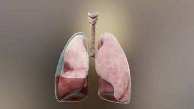 3D Hemopnömotoraks, normal akciğere karşı çökme, Hemopnömotoraks semptomları, plevral efüzyon, empyema, göğüs yaralanmasından sonraki komplikasyonlar, plevral boşluktaki hava, 3D Render