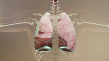 3D Hemopnömotoraks, normal akciğere karşı çökme, Hemopnömotoraks semptomları, plevral efüzyon, empyema, göğüs yaralanmasından sonraki komplikasyonlar, plevral boşluktaki hava, 3D Render