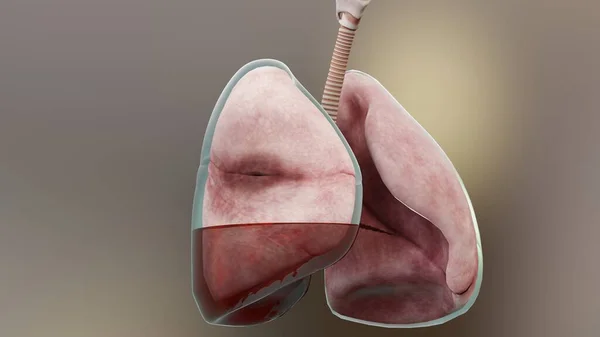 Illustration Des Hämopneumothorax Normale Lunge Kollaps Symptome Des Hämopneumothorax Pleuraerguss — Stockfoto
