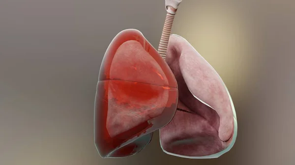 Illustration Des Hämothorax Normale Lunge Kollaps Symptome Des Hämothorax Pleuraerguss — Stockfoto