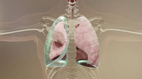 3D说明气胸 正常肺与塌陷 气胸症状 胸腔积液 胸部受伤后并发症 胸腔内空气 — 图库照片