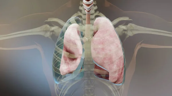 Illustration Des Pneumothorax Normale Lunge Kollaps Symptome Des Pneumothorax Pleuraerguss — Stockfoto