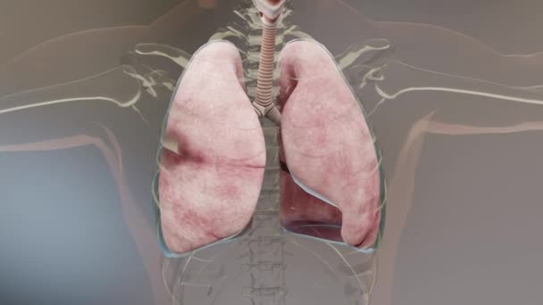 正常肺与塌陷 气胸症状 胸腔积液 胸部受伤后并发症 肺与胸壁之间的胸腔空气 — 图库视频影像