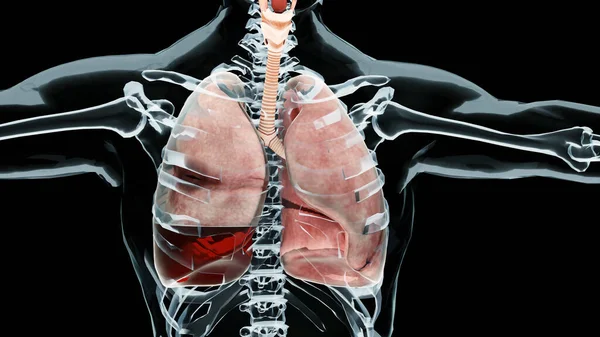 3D Hemopnömotoraks, normal akciğere karşı çökme, Hemopnömotoraks semptomları, plevral efüzyon, empyema, göğüs yaralanmasından sonraki komplikasyonlar, plevral boşluktaki hava, 3D Render