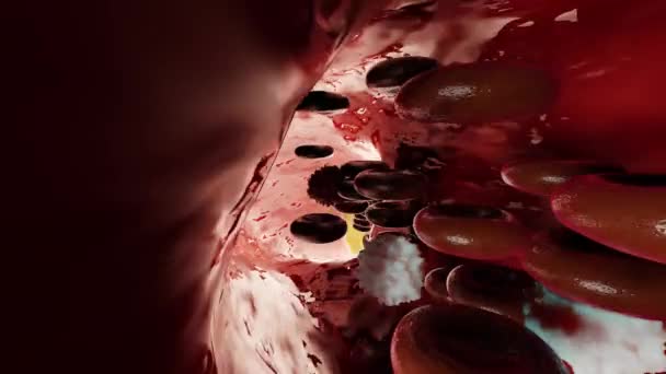 Oclusão Vascular Bloqueio Vaso Sanguíneo Geralmente Com Coágulo Renderização Ataque — Vídeo de Stock