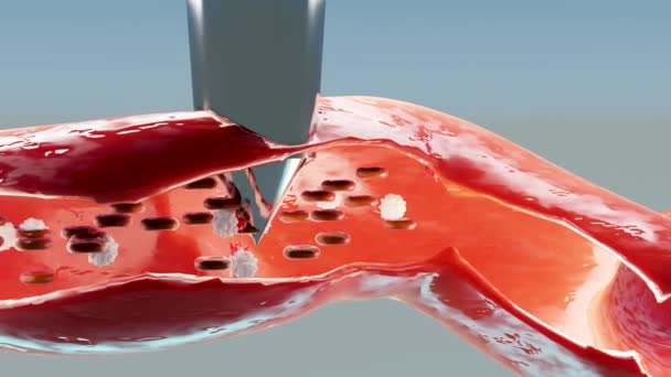止血だ 血管内の赤血球と血小板 創傷治癒の基本的なステップ アニメーションだ 3Dレンダリング 断面図 — ストック動画