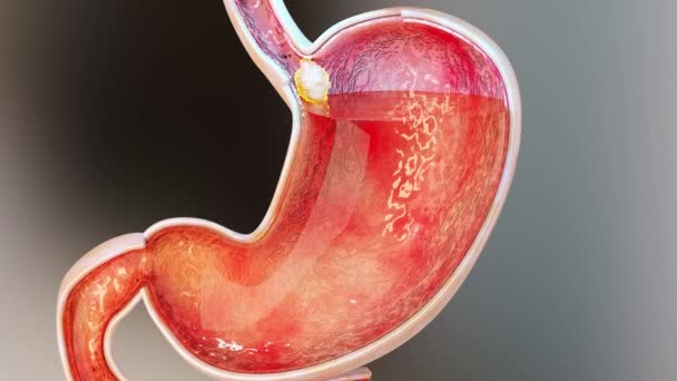 胃の酸のリラックス エソファガス ガード 消化器系の痛み ピロシス 人体器官 3Dレンダリング — ストック動画