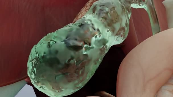 Batu Empedu Saluran Empedu Siluet Manusia Dan Anatomi Organ Sekitarnya — Stok Video