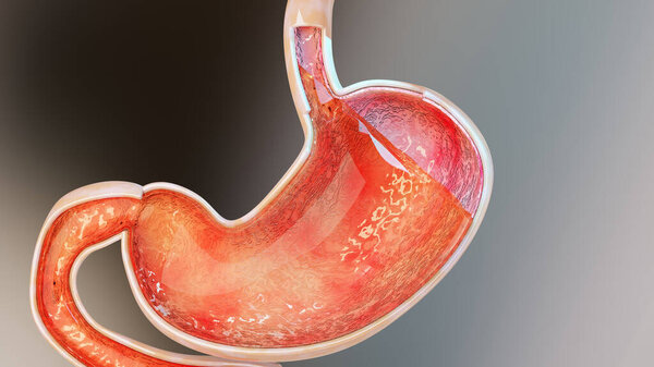 Кислота желудка. Эзофаг, Герд. Боль в пищеварительной системе, гастрит, пироз, орган человеческого тела, 3d рендеринг