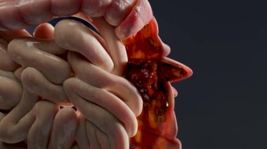 Anatomy of the human digestive system, concept of the intestine, diverticulitis, 3d render